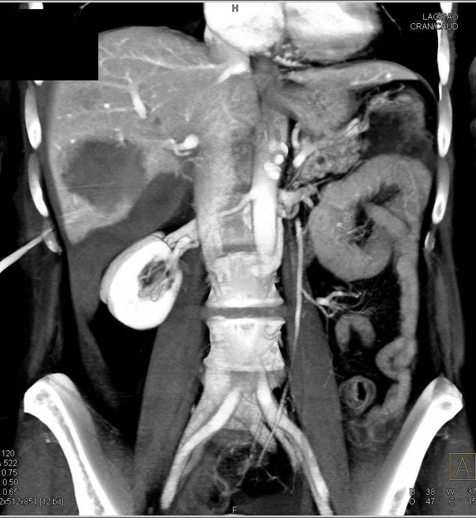 Liver Laceration with Hemoperitoneum - CTisus CT Scan