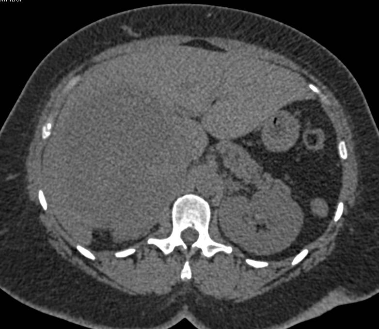 Hepatocellular Carcinoma (Hepatoma) with Neovascularity and Pseudocapsule - CTisus CT Scan