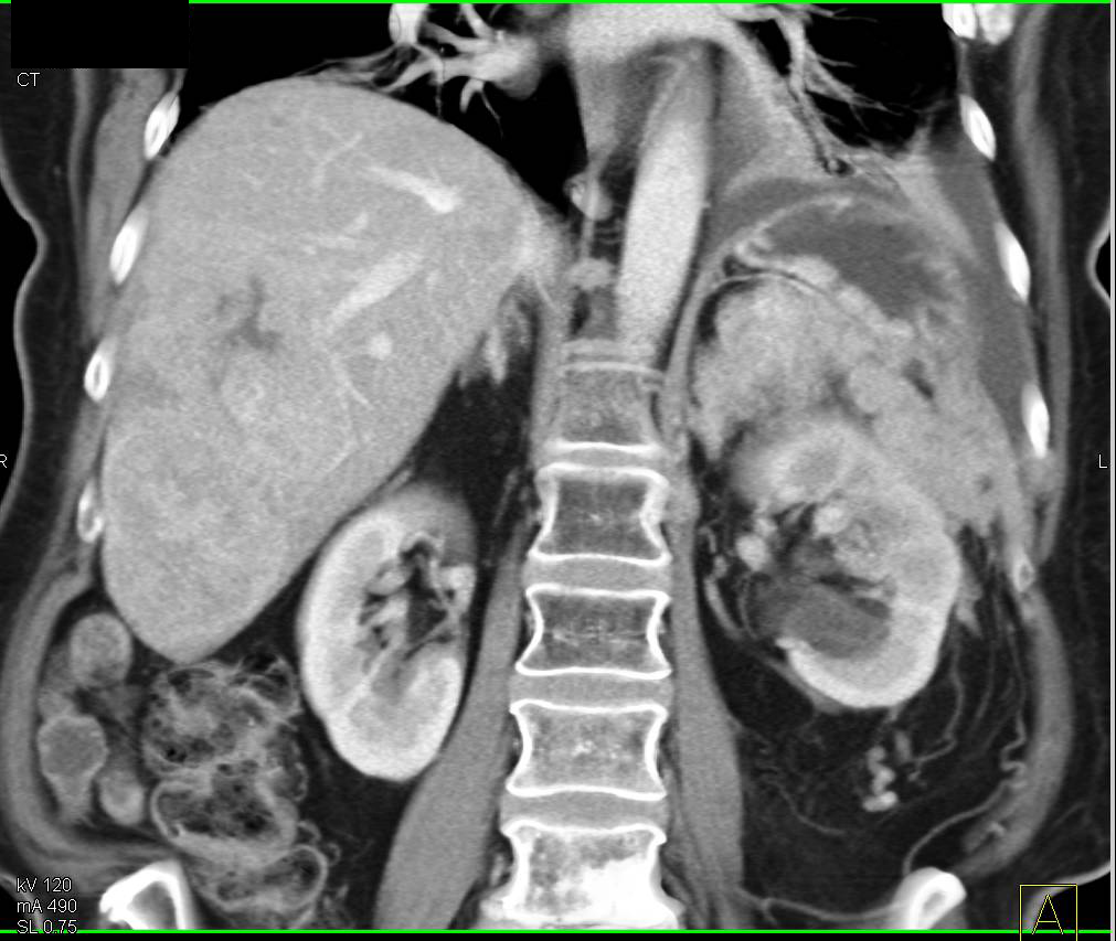 Hepatocellular Carcinoma (Hepatoma) with Adrenal Metatases - CTisus CT Scan