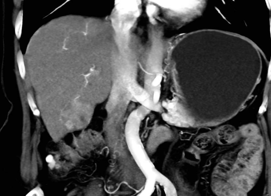 Hepatocellular Carcinoma (Hepatoma) - CTisus CT Scan