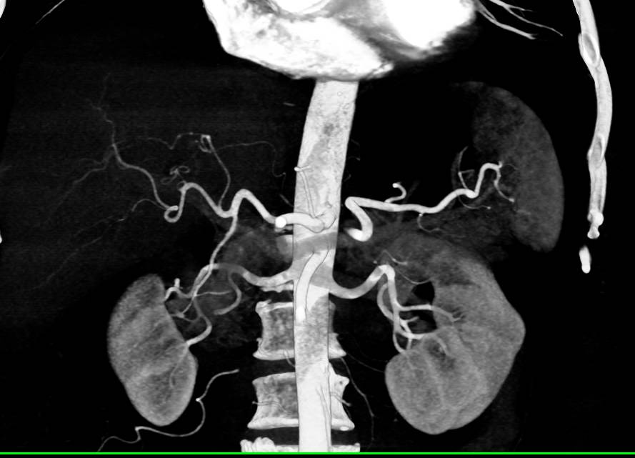 Arteriovenous (AV) Shunt in Liver Simulates a Vascular Tumor - Liver ...