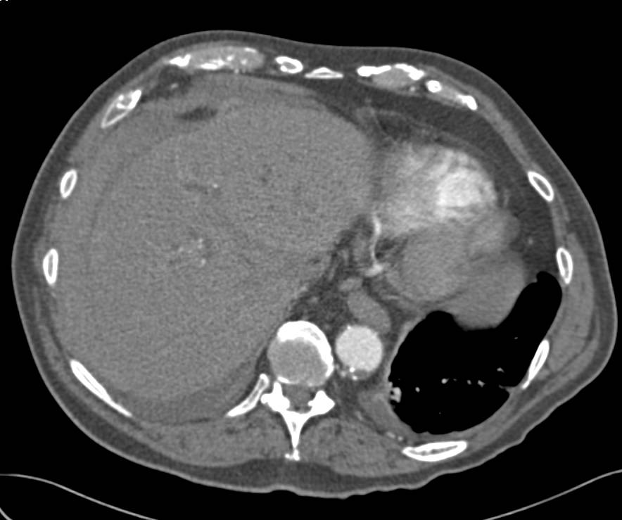 Hepatic Artery Pseudoaneurysm with Subcapsular Bleed - CTisus CT Scan