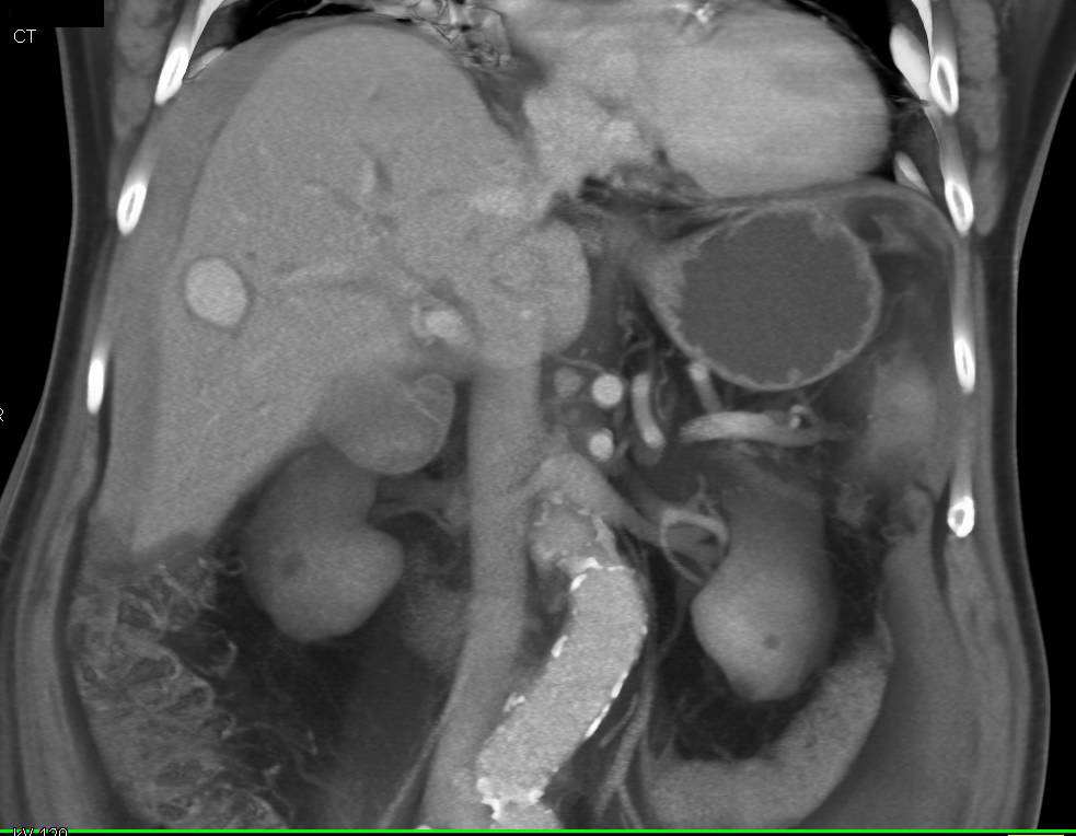 Hepatic Artery Pseudoaneurysm within the Liver - CTisus CT Scan