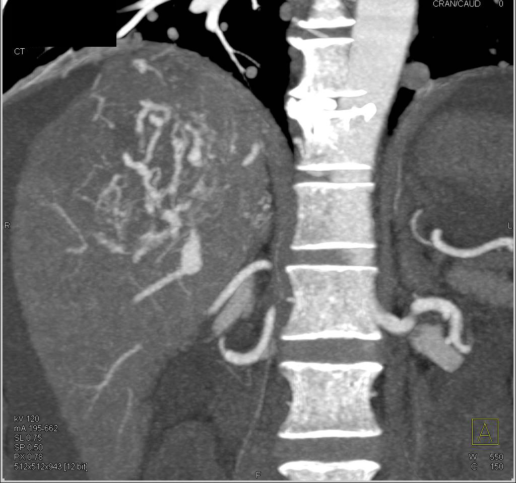 Hepatocellular Carcinoma (Hepatoma) with Neovascularity - CTisus CT Scan