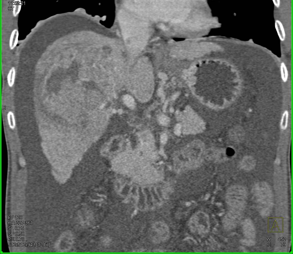 Hepatocellular Carcinoma (Hepatoma) with Pseudocapsule - CTisus CT Scan