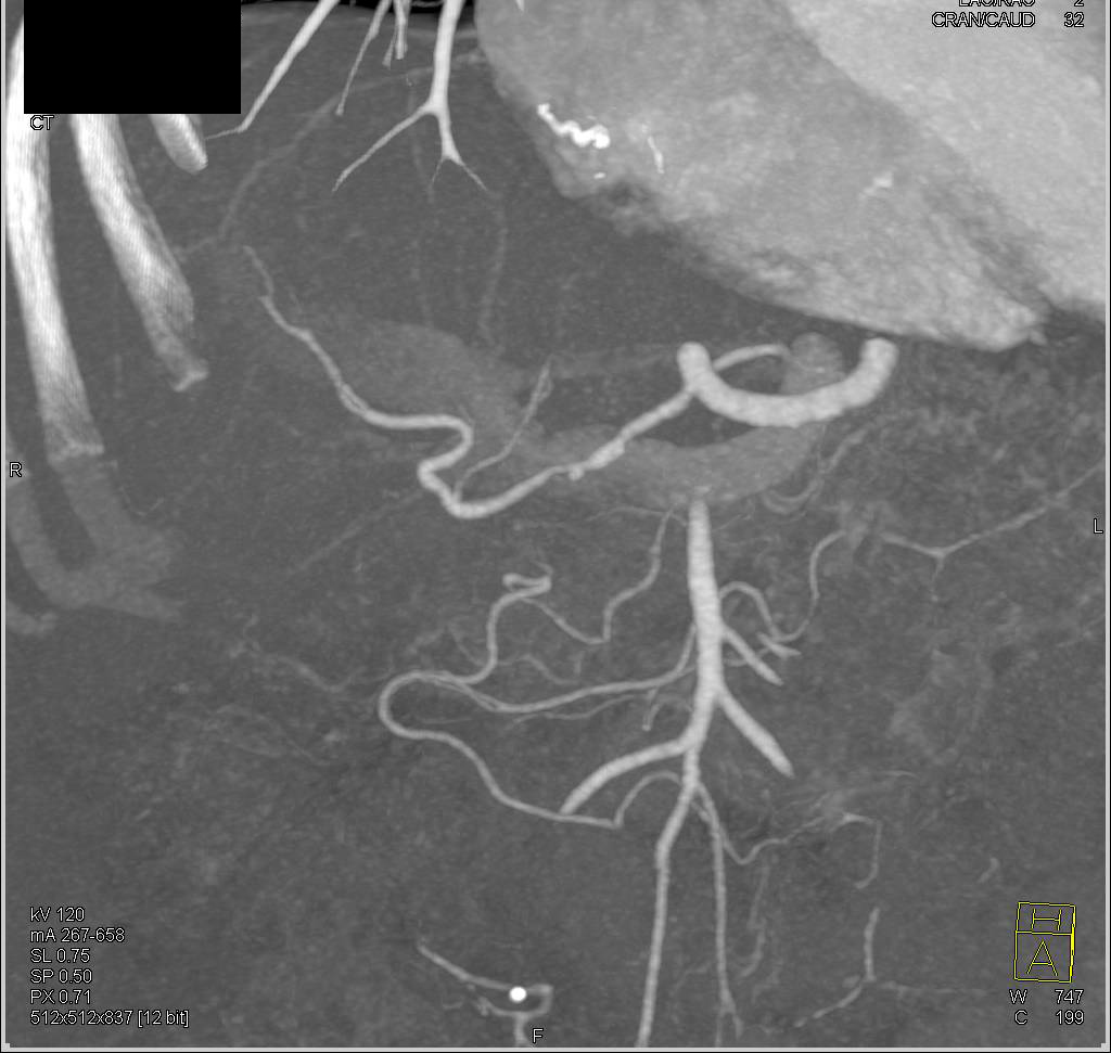 Hepatic Artery Stenosis in a Transplant Patient - CTisus CT Scan