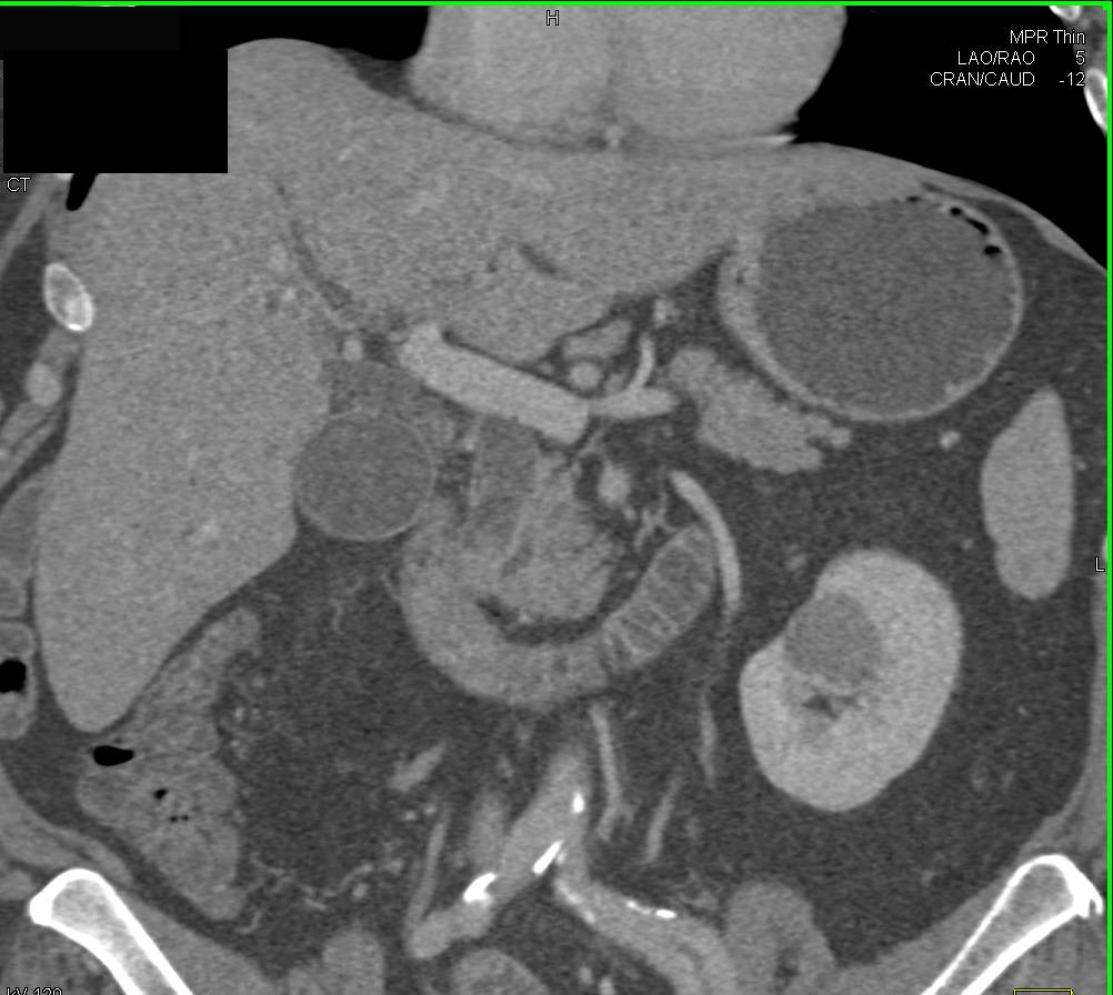 Ampullary Carcinoma with Dilated Common Bile Duct (CBD) - CTisus CT Scan