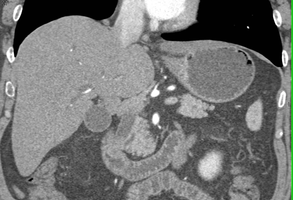 Ampullary Carcinoma with Dilated Common Bile Duct (CBD) - CTisus CT Scan