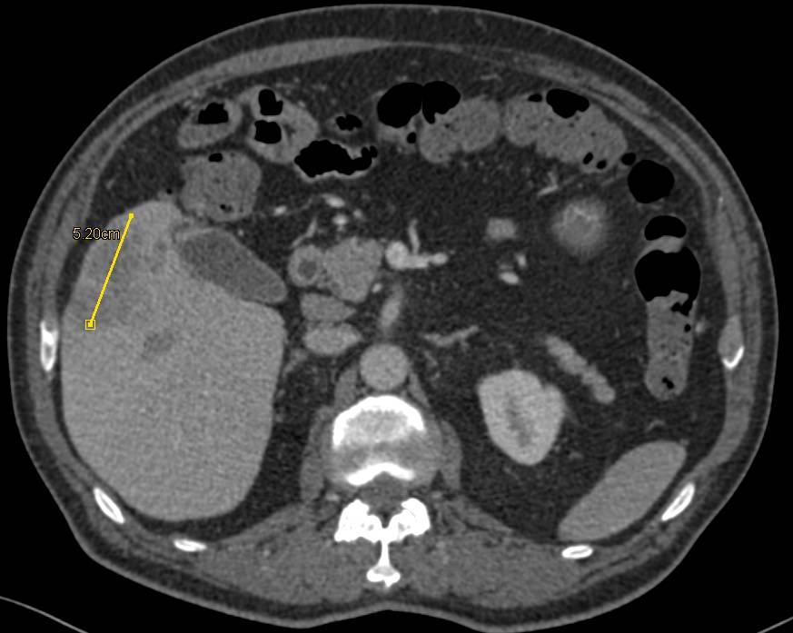 Hepatocellular Carcinoma (Hepatoma) without Neovascularity - CTisus CT Scan