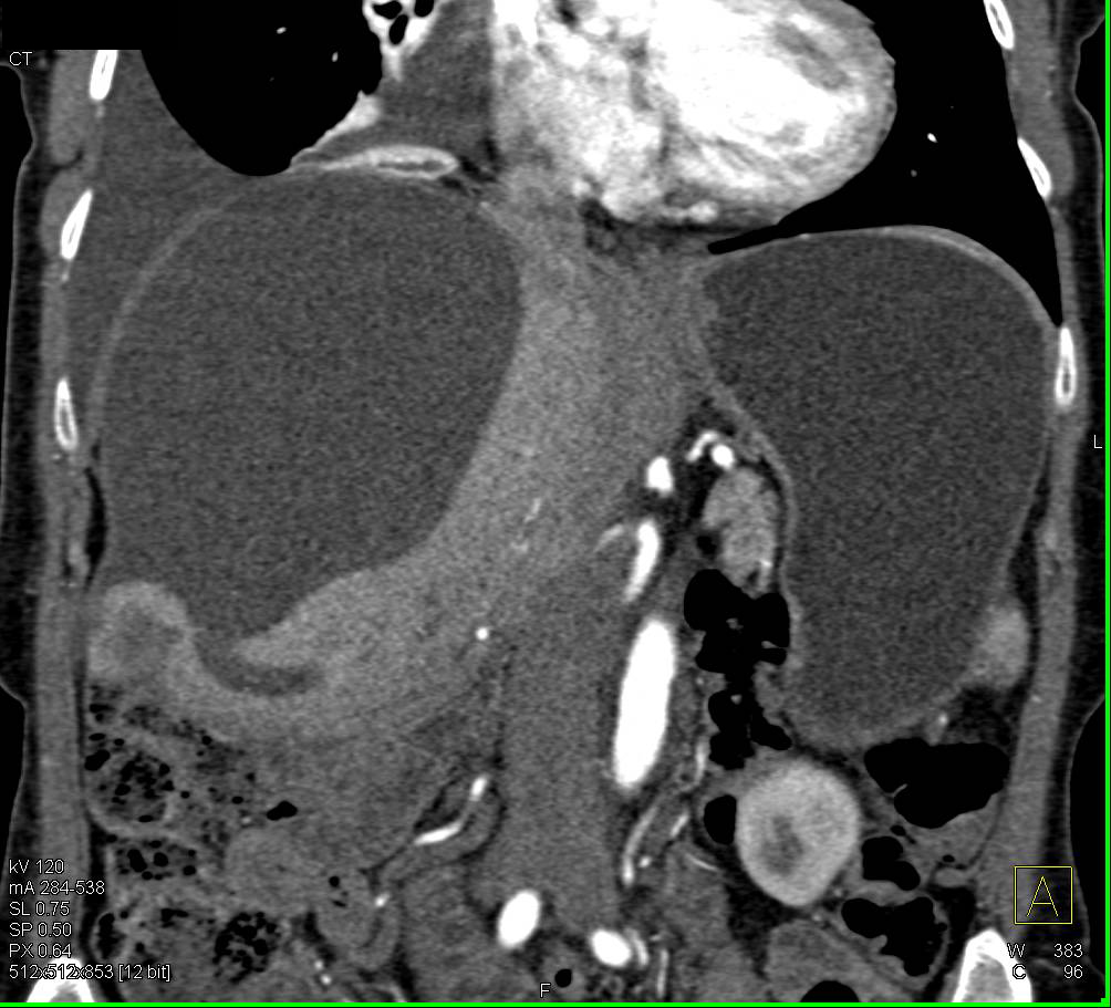 Biloma - CTisus CT Scan