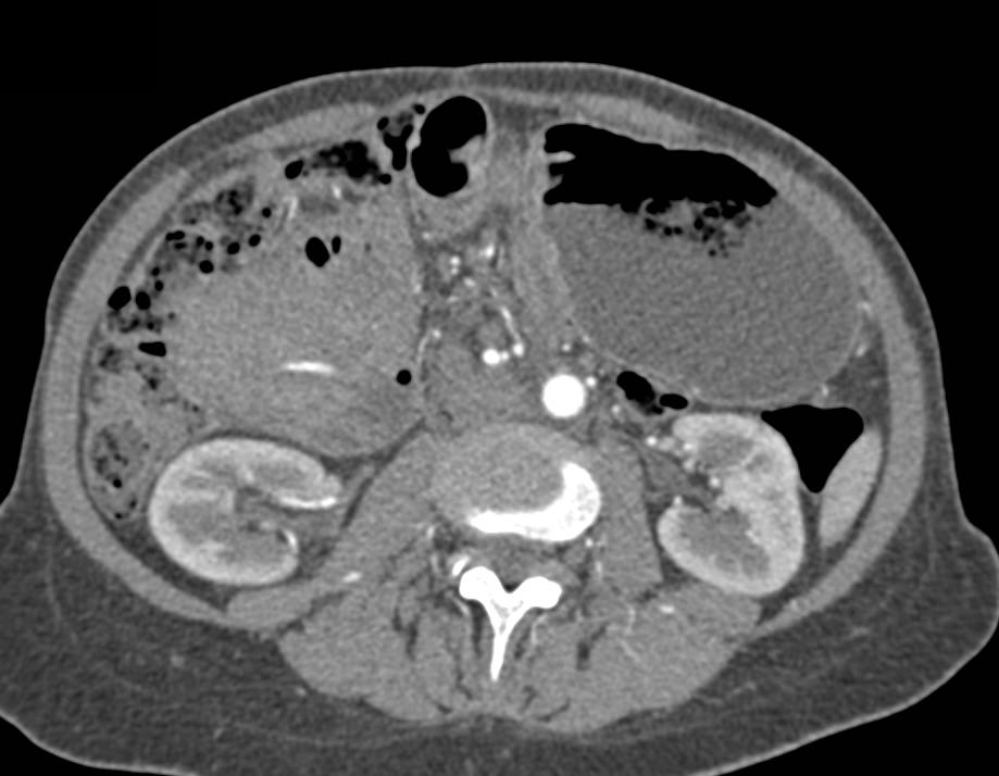 Large Biloma Liver with Liver Compression - CTisus CT Scan