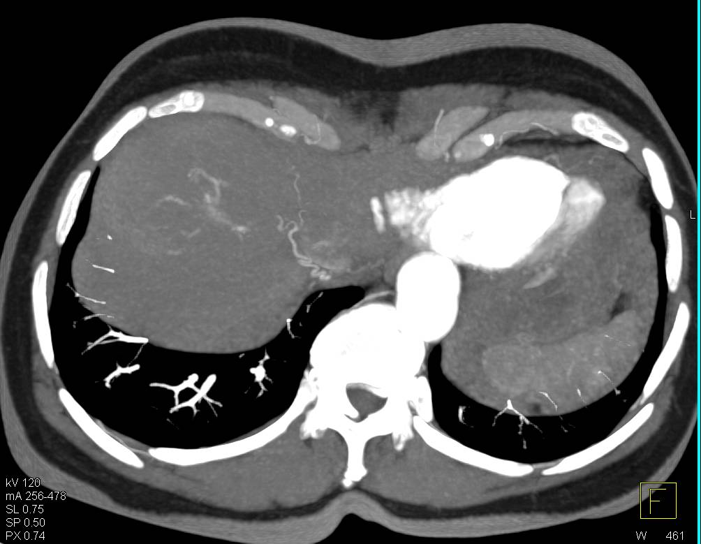 Subtle Hepatocellular Carcinoma (Hepatoma) Seen on MIP Image in Dome of Liver - CTisus CT Scan