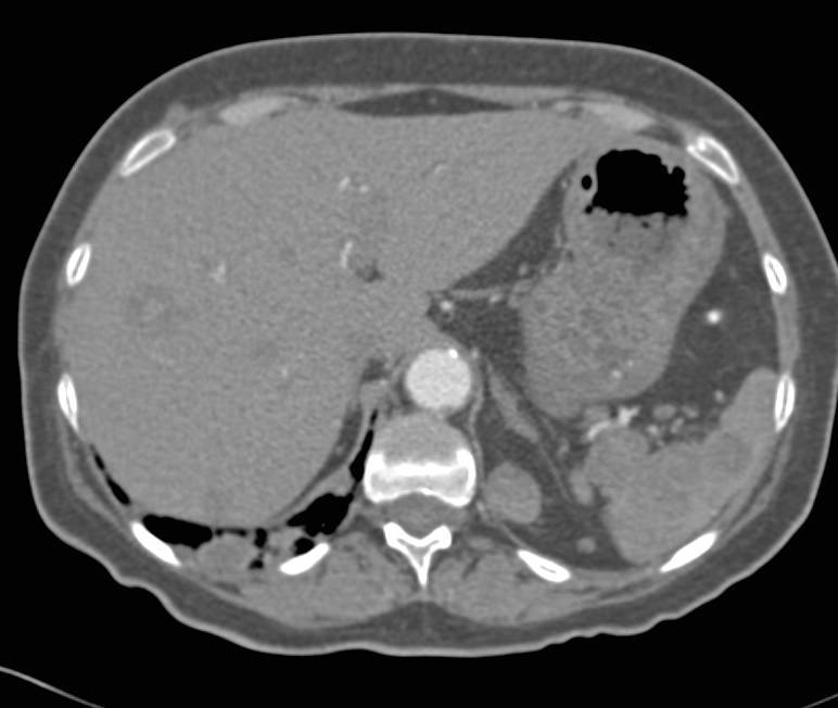 Angiosarcoma with Liver and Muscle Metastases - CTisus CT Scan