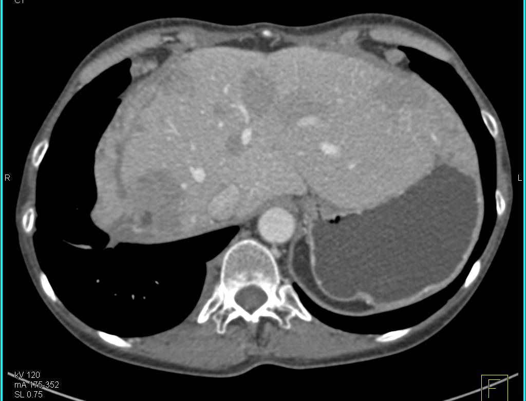 Recurrent Hepatocellular Carcinoma (Hepatoma) with Carcinomatosis - CTisus CT Scan