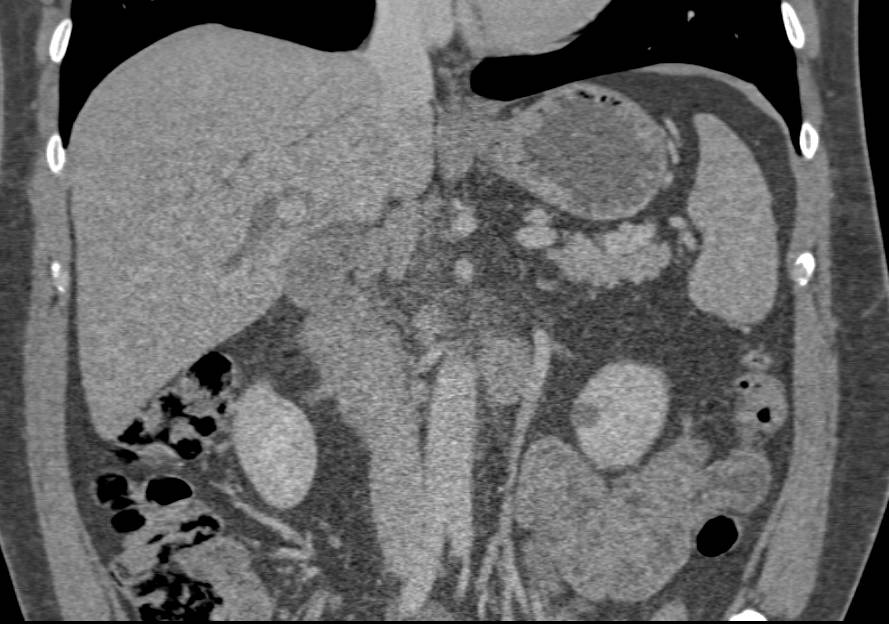 Ampullary Carcinoma Obstructs the Common Bile Duct (CBD) - CTisus CT Scan