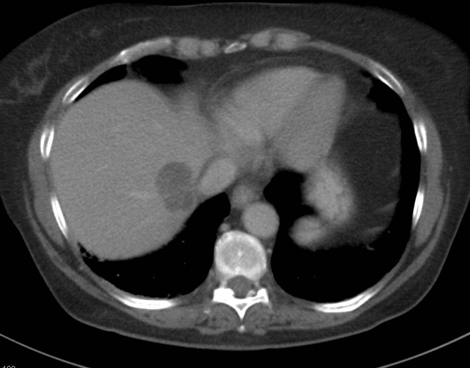 Liver Abscess - CTisus CT Scan