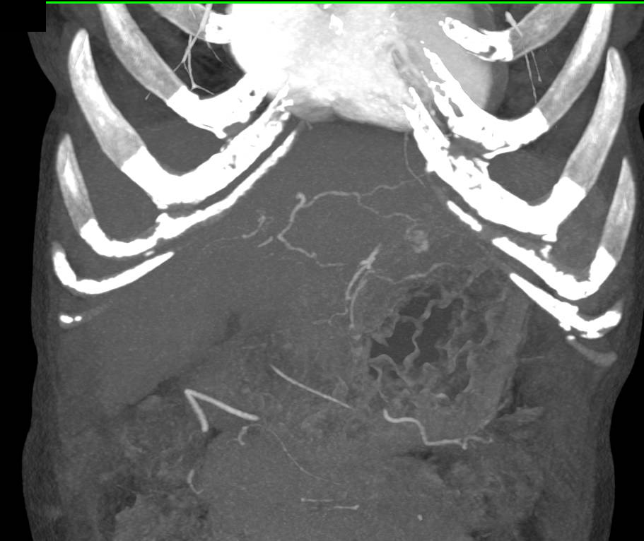 Subtle Hepatocellular Carcinoma (Hepatoma) in a Cirrhotic Liver - CTisus CT Scan