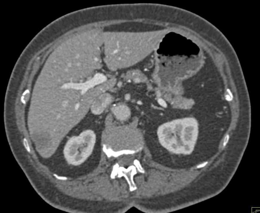 Atypical Hepatocellular Carcinoma (Hepatoma) Seen Best on Venous Phase Imaging - CTisus CT Scan