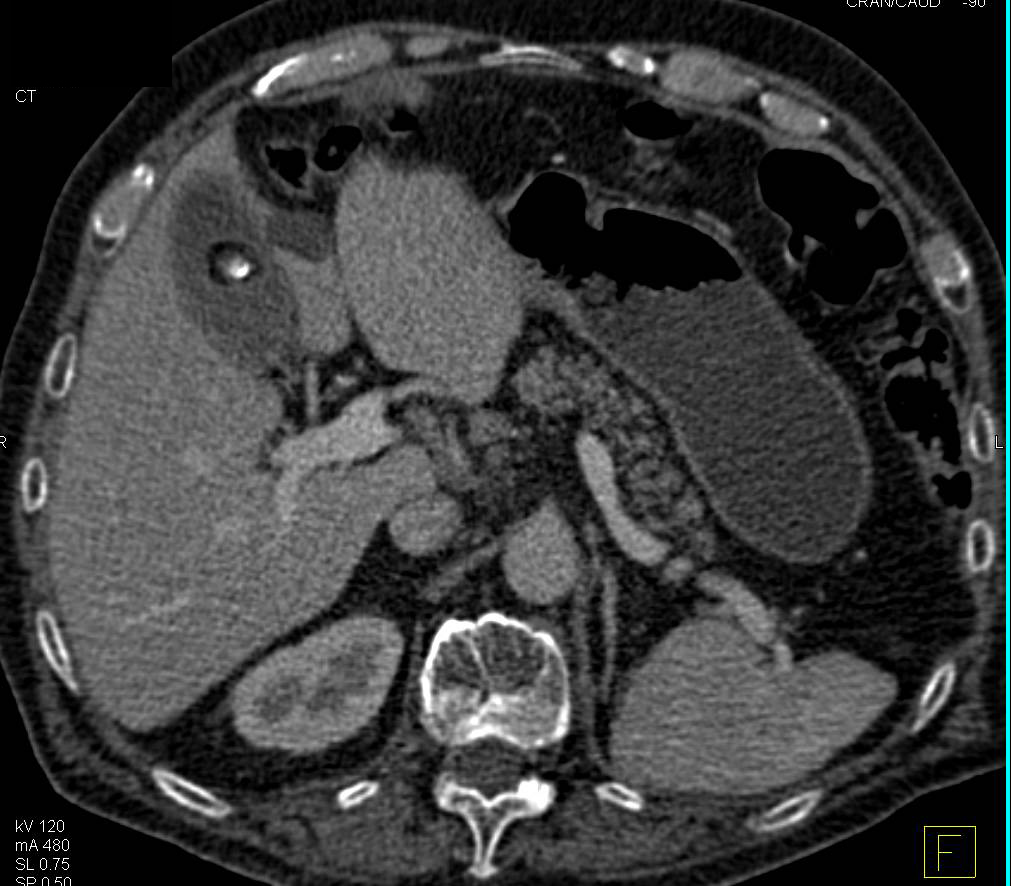 Gallstones and Chronic Cholecystitis - CTisus CT Scan