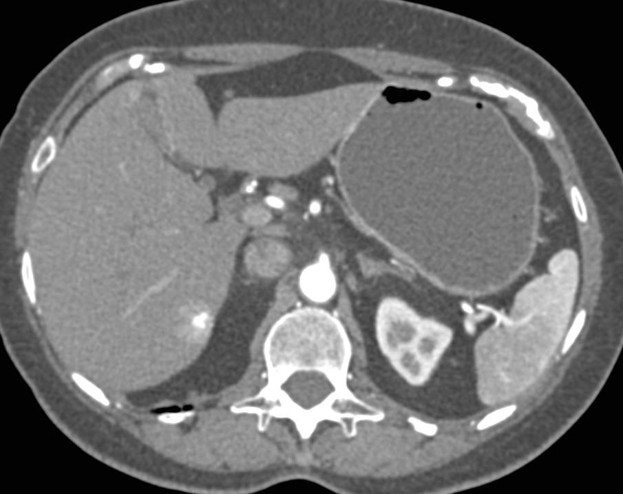 Intraductal Papillary Mucinous Neoplasm (IPMN) in Head of Pancreas and Incidental Flash Filling Hemangioma - CTisus CT Scan