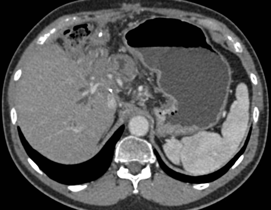 Central Cholangiocarcinoma - CTisus CT Scan