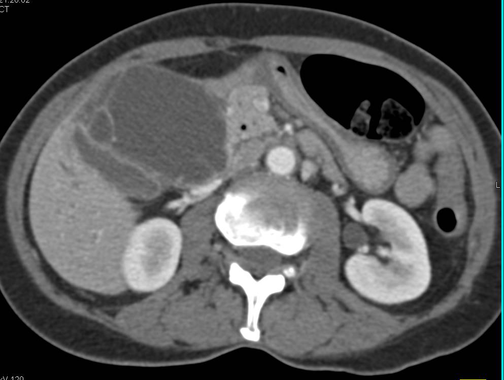 Acute Cholecystitis with Gallbladder Abscess - CTisus CT Scan