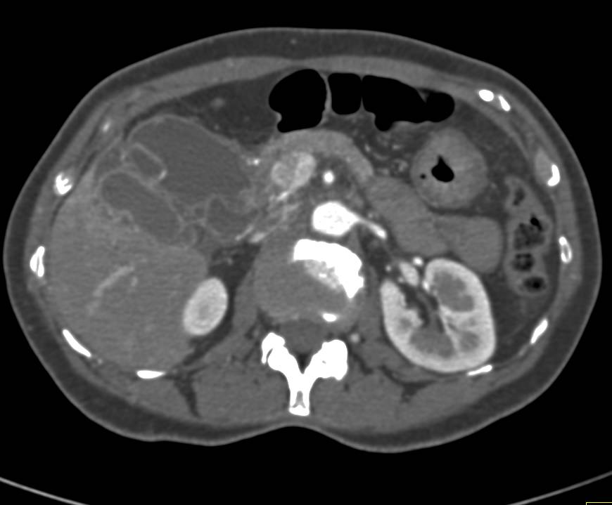 Acute Cholecystitis with Gallbladder Abscess - Liver Case Studies