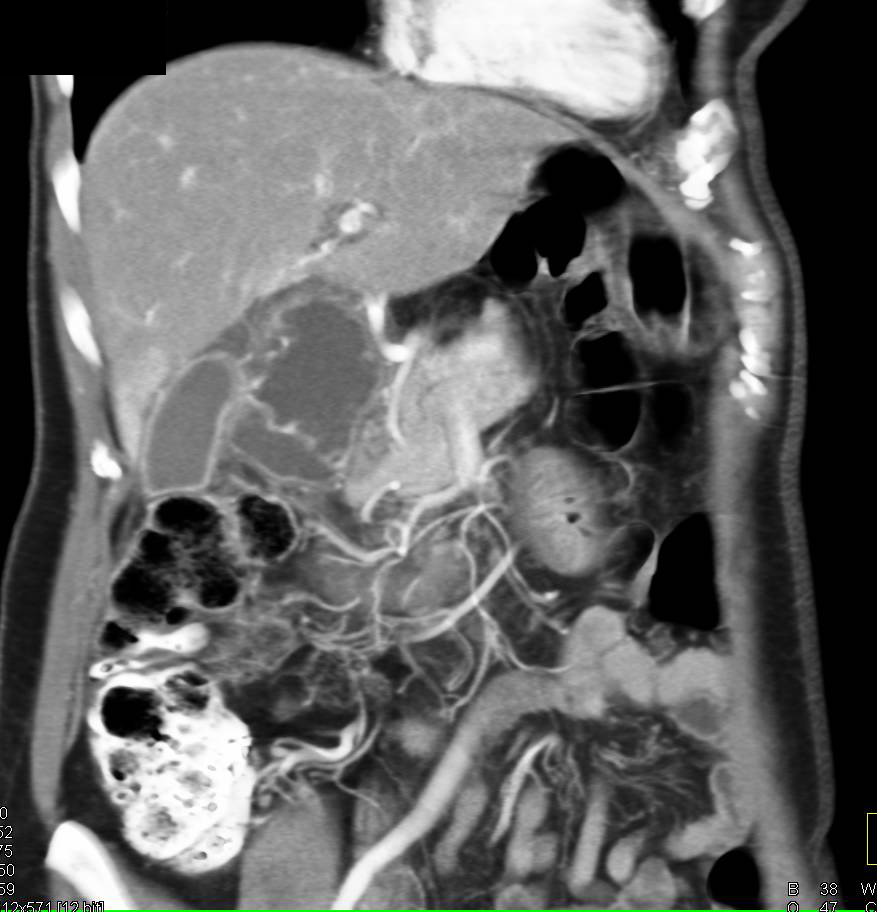 Acute Chiolecystitis - CTisus CT Scan