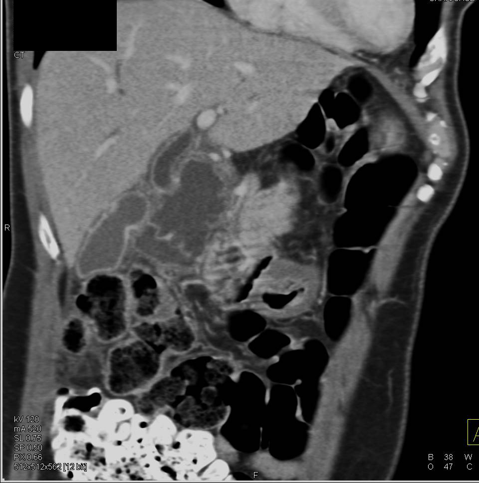 Gallbladder Abscess - CTisus CT Scan