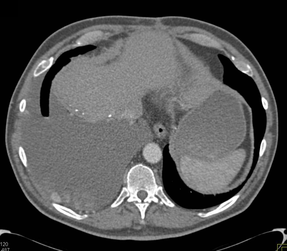 Recurrent Hepatocellular Carcinoma (Hepatoma) with Pleural and Parenchymal Metastases - CTisus CT Scan