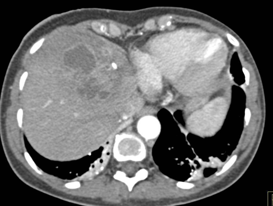 Cholangiocarcinoma Left Lobe of the Liver - CTisus CT Scan