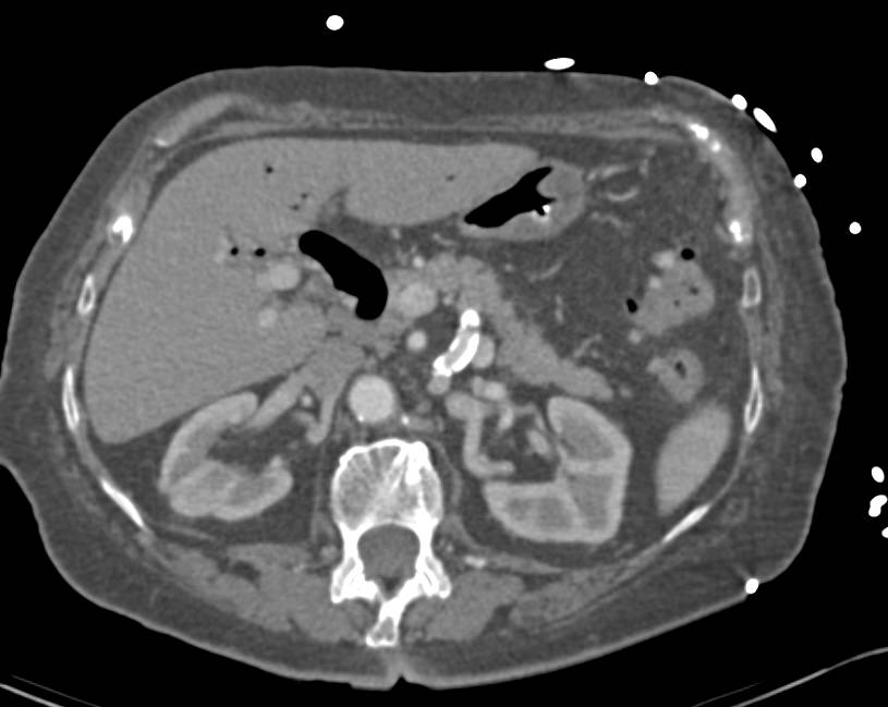 Incredible Case of Gallstone Ileus - Liver Case Studies - CTisus CT ...