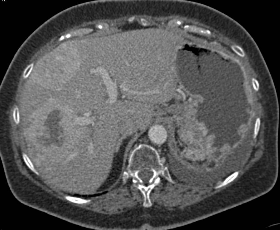 Neuroendocrine Tumor with Liver Metastases - CTisus CT Scan