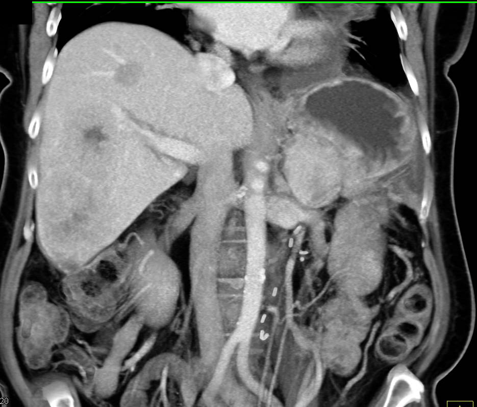 Hepatocellular Carcinoma (Hepatoma) with Renal Metastases - CTisus CT Scan