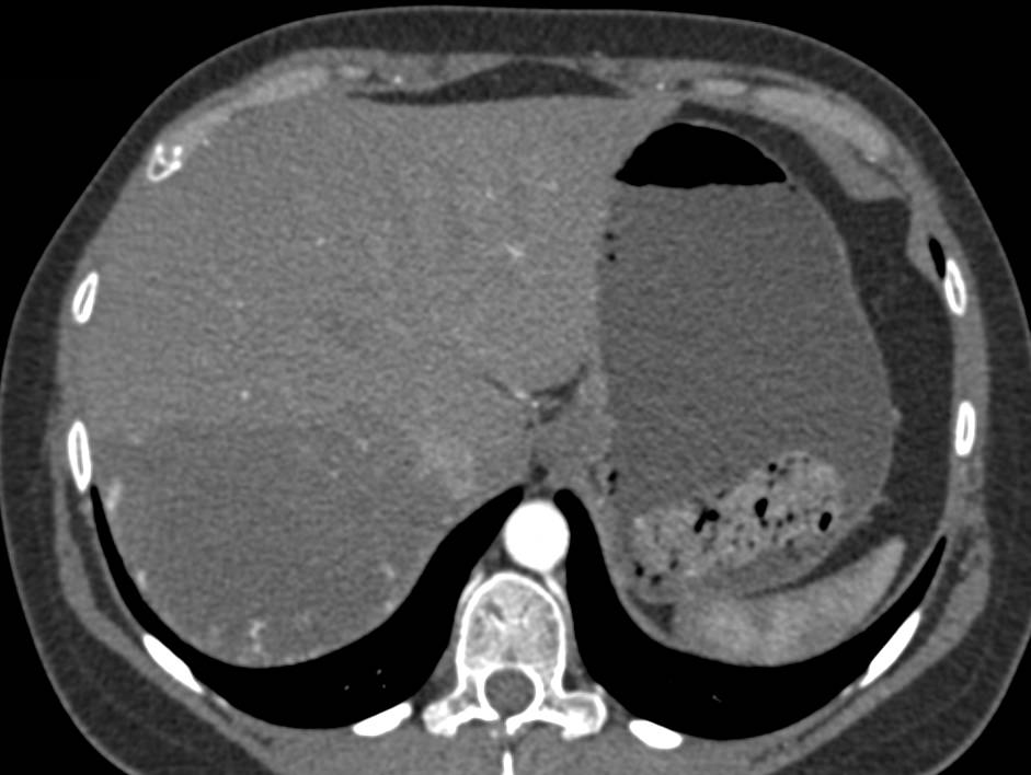 Cavernous Hemangioma of the Liver - CTisus CT Scan