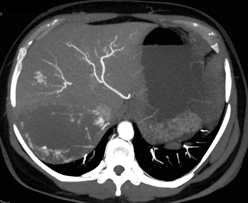 Hepatic Hemangiomas - CTisus CT Scan