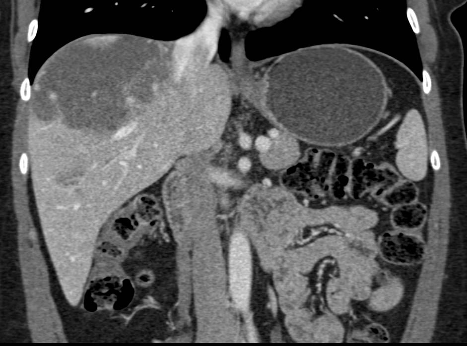 Cavernous Hemangioma of the Liver - CTisus CT Scan