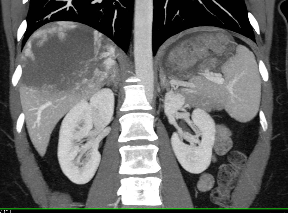 Giant Cavernous Hemangioma of the Liver - CTisus CT Scan