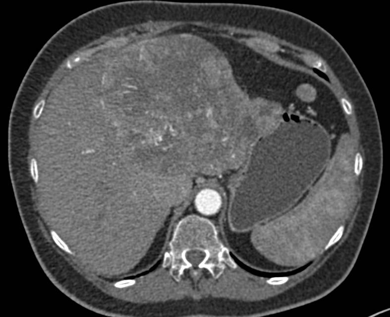 Hepatocellular Carcinoma (Hepatoma) Invades the Inferior Vena Cava (IVC) - CTisus CT Scan