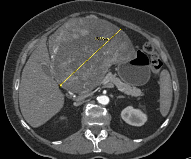 Hepatocellular Carcinoma (Hepatoma) with Neovascularity - CTisus CT Scan