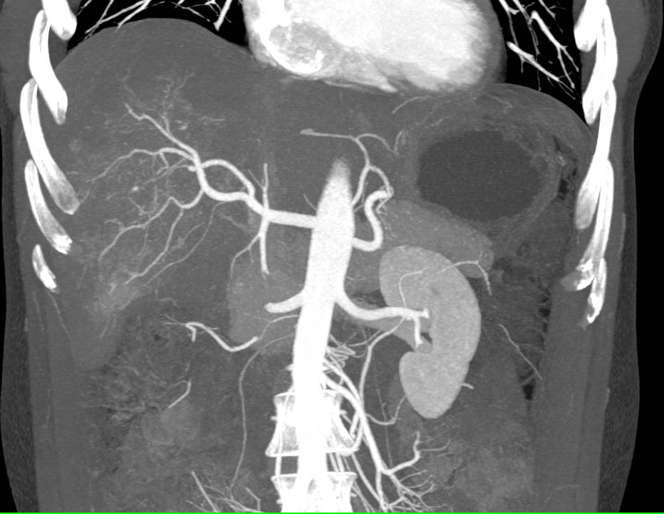 Hepatocellular Carcinoma (Hepatoma) with Neovascularity - CTisus CT Scan