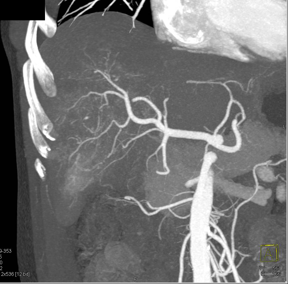 Multiphase Hepatocellular Carcinoma (Hepatoma) with Neovascularity - CTisus CT Scan