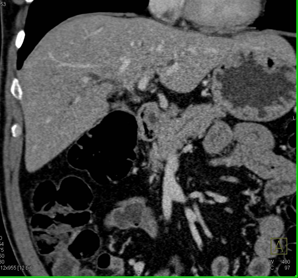 Distal Common Bile Duct (CBD) Tumor with Dilated Common Bile Duct - CTisus CT Scan