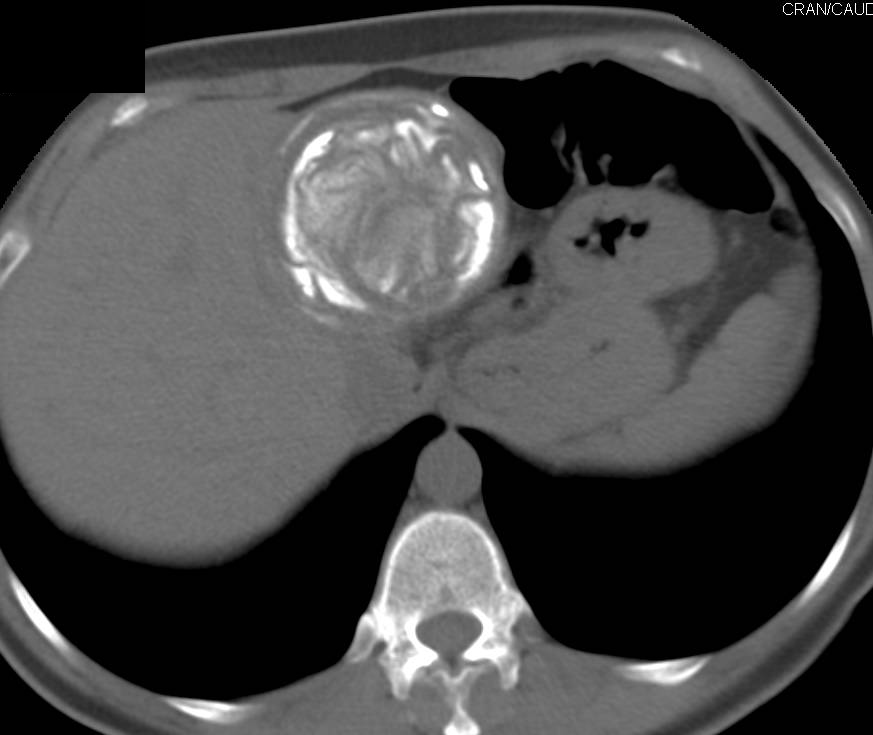 Hydatid Disease - CTisus CT Scan