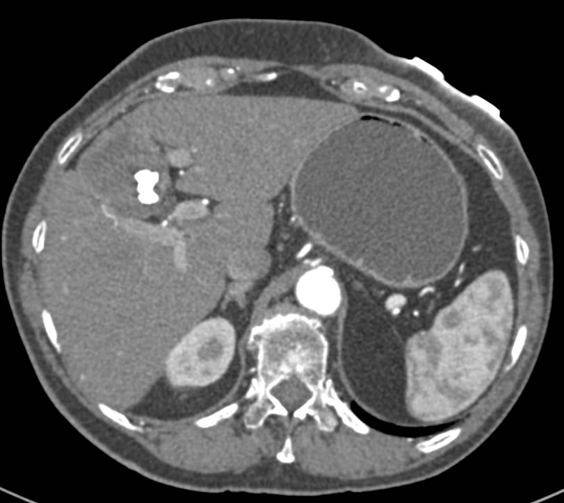 Sclerosed Hemangioma of the Liver - CTisus CT Scan