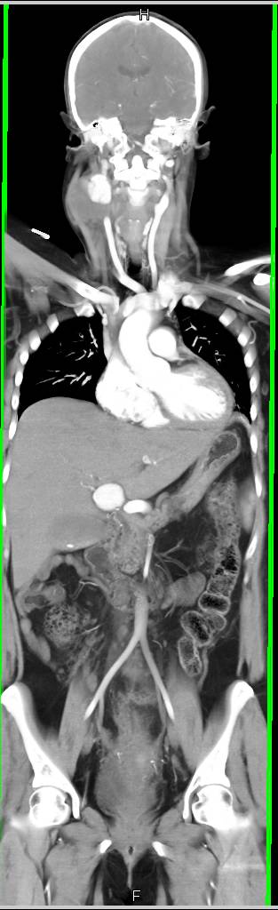 3D CTA of Hepatic Artery Pseudoaneurysm - CTisus CT Scan