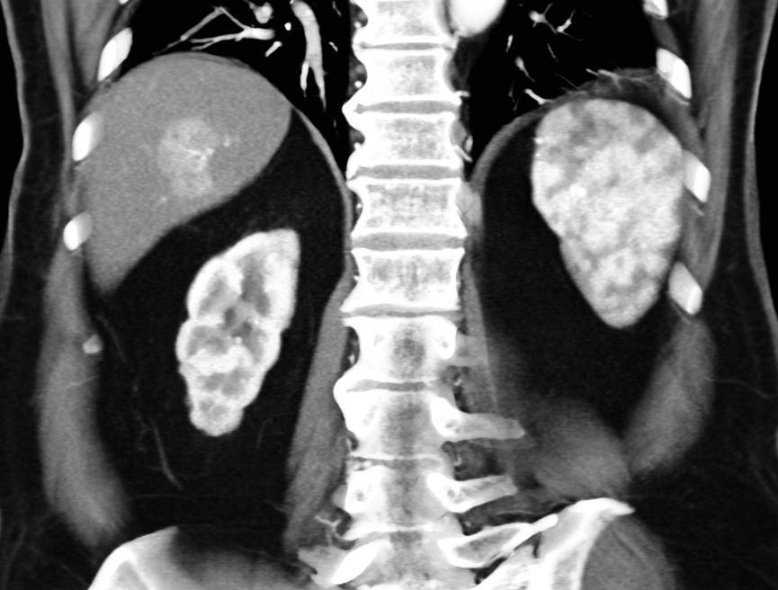 Hemangioma of the Liver - CTisus CT Scan