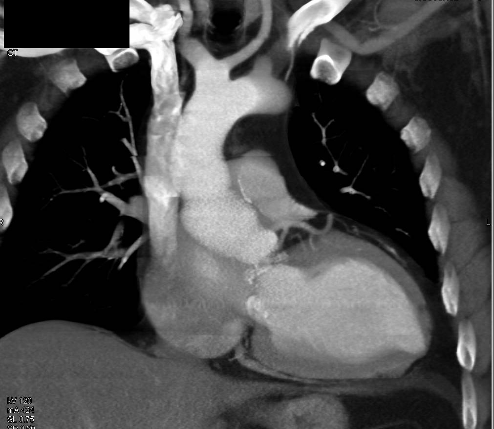 Aortic Root Repair with Reimplanted Coronary Arteries - CTisus CT Scan