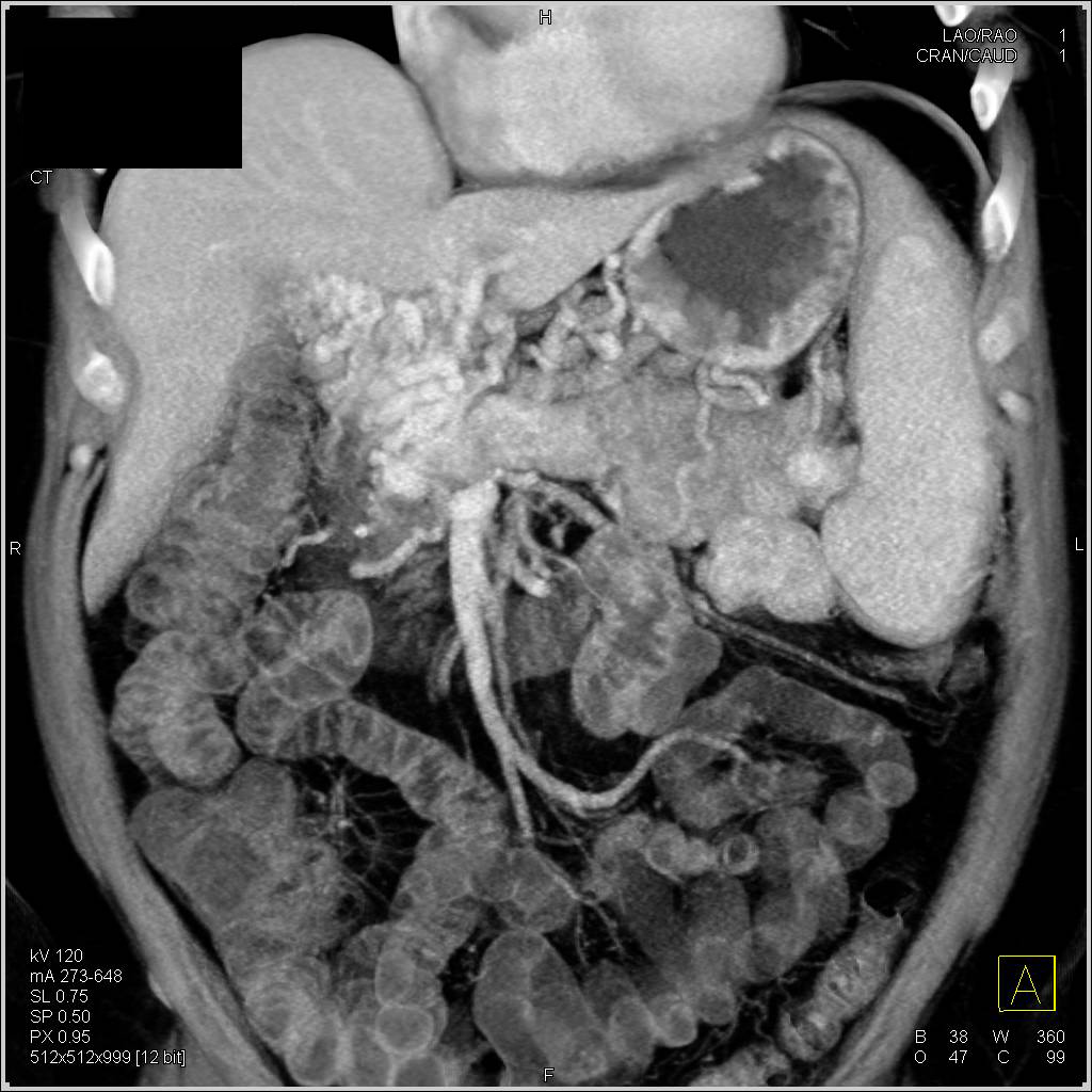 Cavernous Transformation of the Portal Vein in a Patient with Neuroendocrine Tumor - CTisus CT Scan