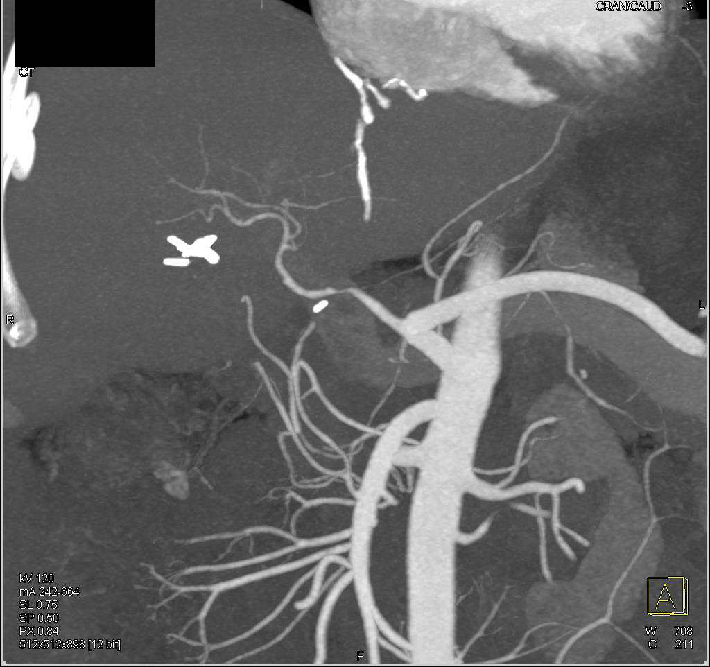 Hepatic Artery Stenosis in a Liver Transplant Patient - CTisus CT Scan